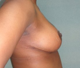 Manhattan Breast Reduction after 1